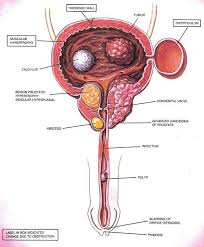 Blood in urine (hematuria), which may cause urine to appear bright red or cola colored, though being male. Bladder Cancer Durward Black Md