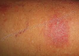Image result for Eczema nummulare