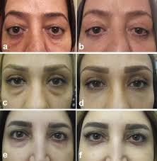 Full article: Lower blepharoplasty; advanced techniques and adjunctive  procedures