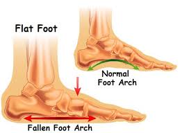 The lump may initially cause little to no pain or discomfort. Foot Arch Pain Causes Treatment Foot Pain Explored