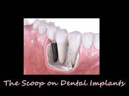 Considering dental implant surgery to replace missing or damaged teeth, but concerned about how bad it will hurt or the pain afterwards?these are common fears. The Scoop On Dental Implants Do They Hurt How Much Do They Cost Youtube