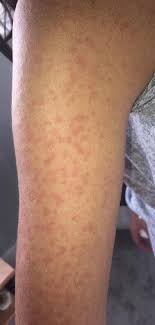 Dry itchy rash on arms and legs. Skin Rash Should Be Considered As A Fourth Key Sign Of Covid 19