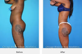 At mia aesthetics, we give our patients many different payment options . How Much Does Brazilian Butt Lift Surgery Cost Bbl Cost In Chicago Illinois Chicago Breast Body Aesthetics Bbl Cost Bbl Surgery