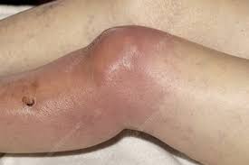 Image result for Septic Joint