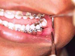 Wait till your dentist decide to remove them after achieving the goal of using them for treatment. How To Fix Braces At Home Jamesburg Nj