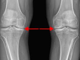 Image result for Knee XRay