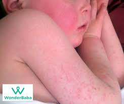 Image result for Scarlet Fever