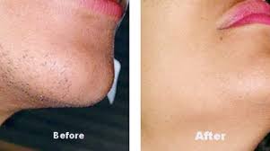Our before & after results speak for themselves. Laser Hair Removal In Brighton Off Skin Laser Clinic