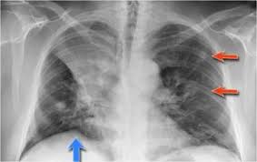 The Radiology Assistant Chest X Ray Lung Disease Lung Disease Medical Radiography Lunges