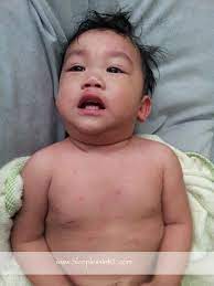 Once the chickenpox rash appears, it goes through three phases: Chicken Pox Strikes Sleepless In Kl