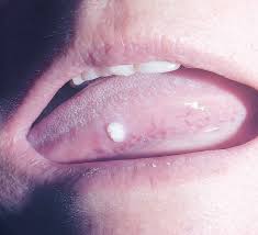 Image result for papillomavirus tongue)