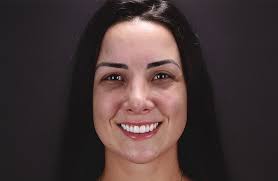 Plástica gengival para revelar o sorriso– Ruzzarin Odontologia