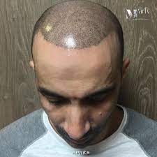calvitie homme calvitie traitement calvitie diffuse calvitie age calvitie frontale repousse cheveux repousse c chute de cheveux perte de cheveux cheveux