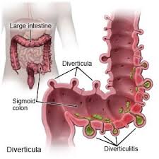 Image result for Diverticulitis