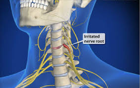 Check spelling or type a new query. Cervical Radiculopathy Treatment And Assessment ð—£ ð—¥ð—²ð—µð—®ð—¯