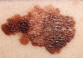 Find facts and statistics for reporting about skin cancer. Melanoma Wikipedia