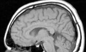 Observation through imaging such as mri scans at certain intervals; New Pet Radiotracer Proven Safe And Effective In Imaging Malignant Brain Tumours Ecancer