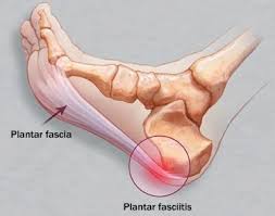 Sakit Telapak Kaki Plantar Fasciitis Solusi Buat Semua Masalah Orthopedic