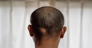 Image result for Alopecia