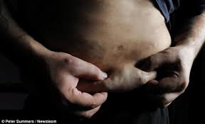 Dercum S Disease Sufferer Who S Covered In Hundreds Of Balls Of Fat Daily Mail Online