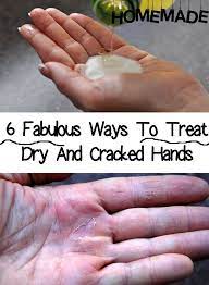 6 Fabulous Ways To Treat Dry And Cracked Hands Cracked Hands Nail Care Tips Skin Care Recipes