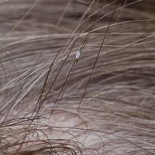 Image result for white scabs on the head in children