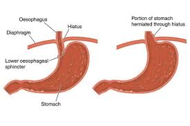 Hiatus Hernia Health Navigator Nz