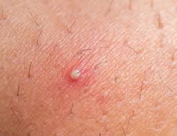 After you notice the ingrown hair, stop shaving, waxing, and plucking your pubic area. Trimming And Shaving Your Pubic Hair How To Get It Right Hair Free Life