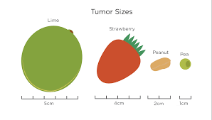 A tumor of any size has spread into the chest wall or skin of the breast, causing swelling or an ulcer to develop. Stages Grades Of Breast Cancer My Breast Cancer Compass