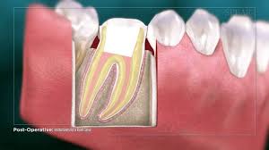 Brush your teeth at least twice a day. What To Do After Root Canal Treatment Root Canal Aftercare