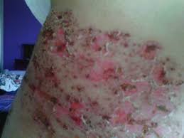 Check 'kayap' translations into english. Ubat Kayap Herpes Zoster Shingle Medicine Photos Facebook