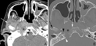 Image result for Osteomyelitis Bone Scan