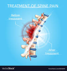 Treatment Of Spine Pain Realistic Chart