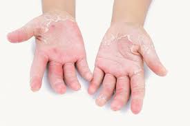 Image result for psoriasis