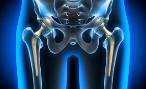 Check spelling or type a new query. Prevent Hip Replacement Dislocation