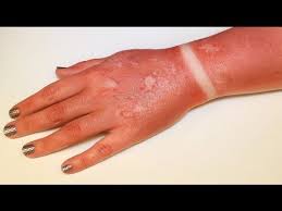 Pictures and information about first, second, and third degree burn symptoms and treatments. Fx Makeup Series First Degree Burn Sunburn Youtube