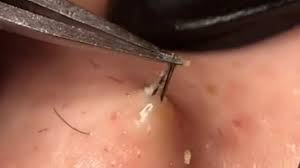 Oily skin can also lead to. Watch How Professionals Remove Ingrown Hairs