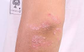 Psoriasis, psoriasis no especificada (trastorno) psoríase das superfícies de flexão, psoríase inversa. Psoriase Entenda As Causas Sintomas E Controle Da Doenca Revista Galileu Saude