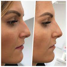 Nasenkorrektur Ohne Op Ab 229 Bei M1 Med Beauty