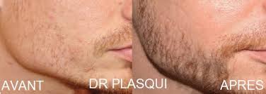 La greffe de barbe et de moustache est indiquée aux hommes qui sont imberbes, ont une barbe clairsemée ou souhaitent masquer une cicatrice. Greffe De Barbe 6 Mois Pour Arborer Une Belle Barbe De Bucheron