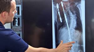 Skoliose Symptome Und Behandlung Ndr De Ratgeber Gesundheit