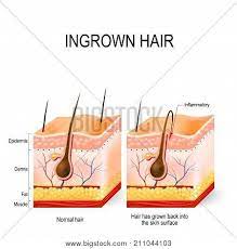 Hair follicles grow back into the skin on the vag labia or lips, causing a small bump. Ingrown Hair After Vector Photo Free Trial Bigstock