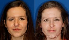 Get the ingredients out of the kitchen (or the bathroom) and say goodbye to that awkward pimple on your nose with ease. Bulbous Nose Tip After Rhinoplasty
