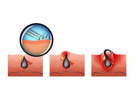 Pickel unter der haut sind kaum sichtbar, aber dafür sehr schmerzhaft. Eingewachsene Haare Sicher Und Schmerzlos Entfernen Hair Guide Net