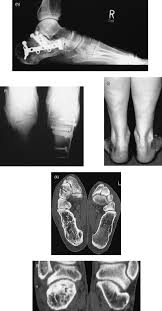 Image result for Calcaneus Compression Fracture