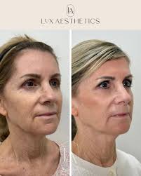 When you're ready for that next-level result and can commit to the journey…  DEKA CO₂ has officially entered the chat. Think our gentle CoolPeel CO₂,  but multiply the results fivefold. This isn't