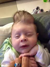 Bentleys Gehirn wächst ausserhalb des Schädels