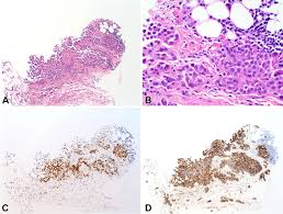 Check spelling or type a new query. Malignant Peritoneal Mesothelioma And Crohn Disease Journal Of Clinical Pathology