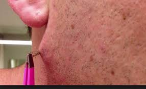 You'll usually feel pressure in. Ingrown Hair Acne