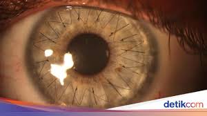 Maybe you would like to learn more about one of these? Bikin Ngilu Atau Kagum Begini Potret Jahitan Pada Kornea Mata